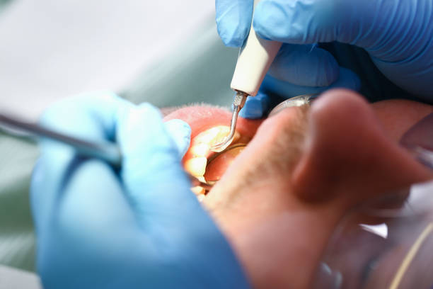 Best Emergency Dental Extractions in Newton, AL
