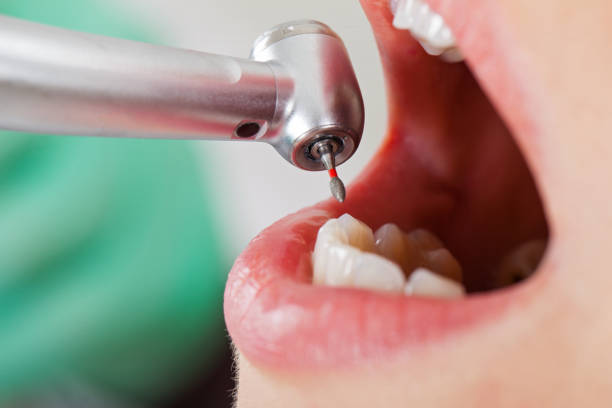 Best Broken or Cracked Tooth Emergency Dentist in Newton, AL